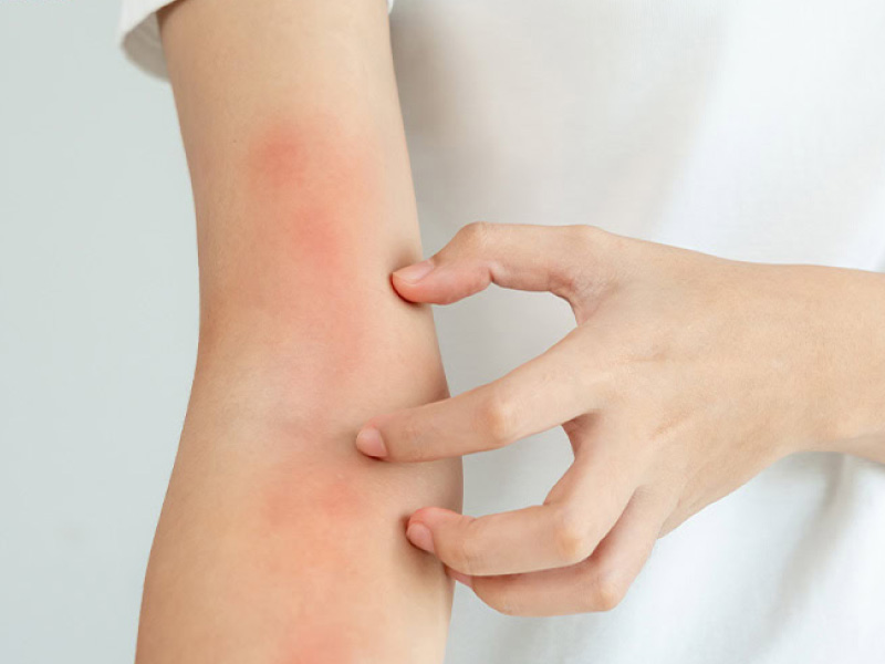 Formaldehyde ảnh hưởng tới da